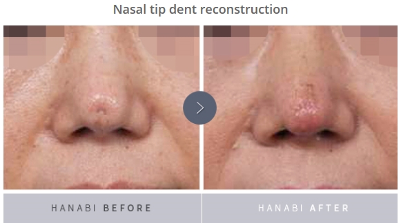 鼻形成術　Rebuilding Nose 鼻形成術 Rebuilding Nose | 鄭載用(ジョン・ジェヨン), Jaeyong Jeong