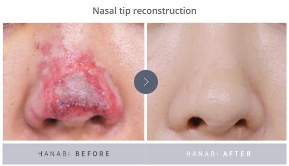 Hanabi Reconstructive nose surgery – HANABI RHINOPLASTY CLINIC