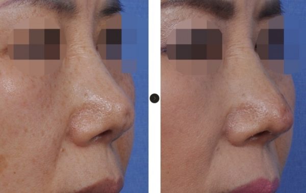 Hanabi Reconstructive nose surgery – HANABI RHINOPLASTY CLINIC Hanabi Reconstructive nose surgery – HANABI RHINOPLASTY CLINIC