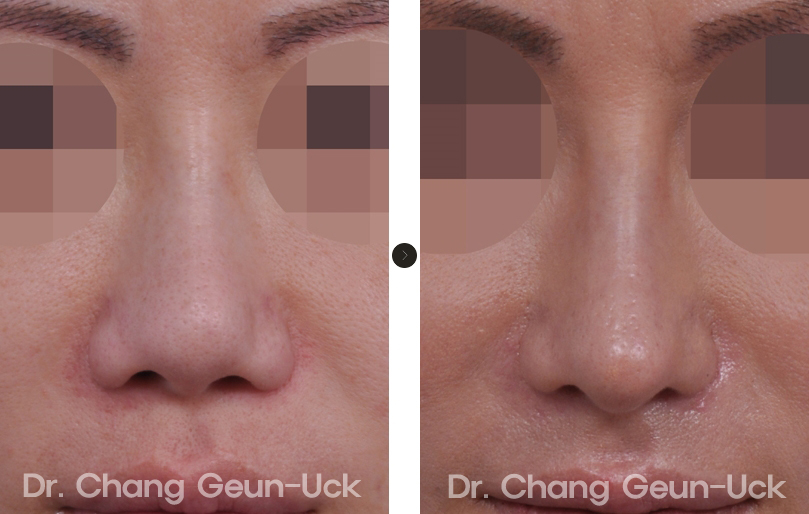 A case of short nose rhinoplasty HANABI RHINOPLASTY CLINIC
