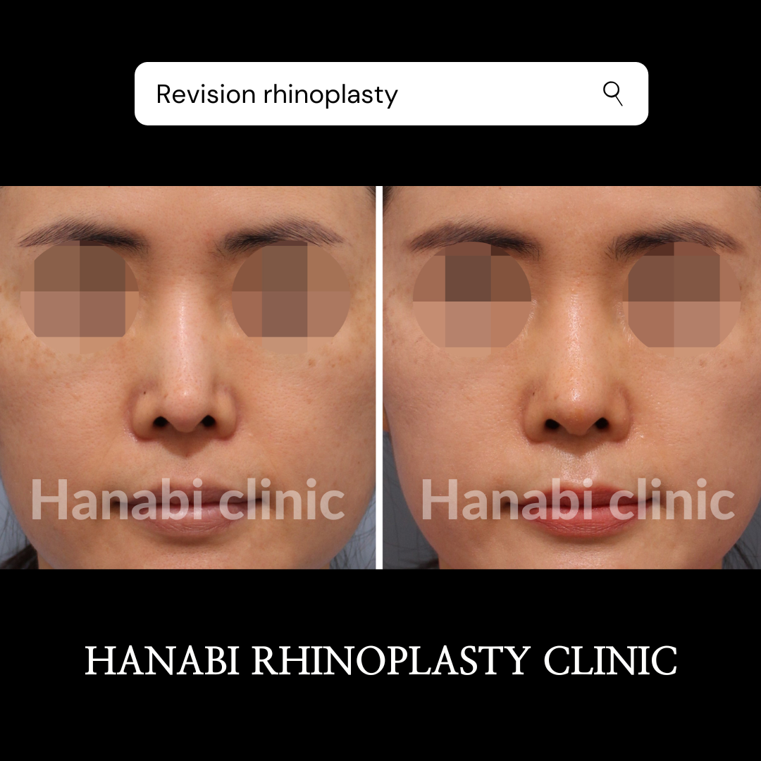 Pinched nose revision rhinoplasty before and after – HANABI