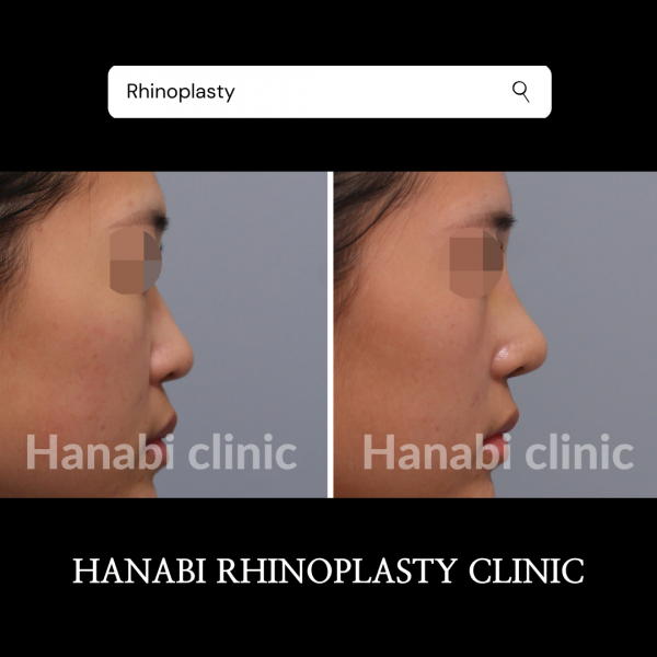 鼻形成術　Rebuilding Nose 鼻形成術 Rebuilding Nose | 鄭載用(ジョン・ジェヨン), Jaeyong Jeong