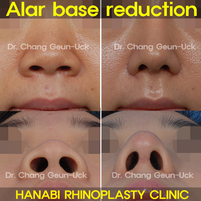 Alar Base Reduction Surgery HANABI RHINOPLASTY CLINIC