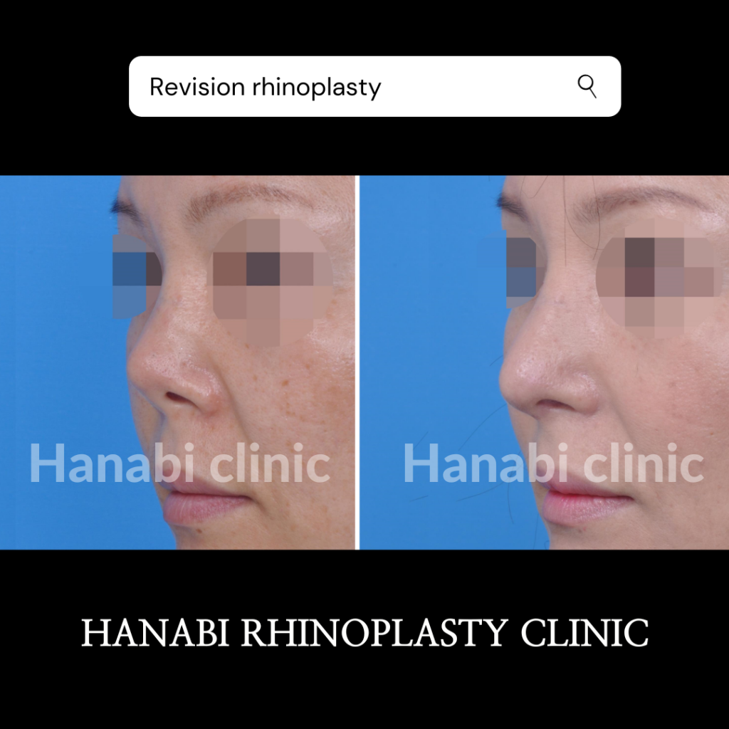Before & after photo of contracted nose correction – HANABI