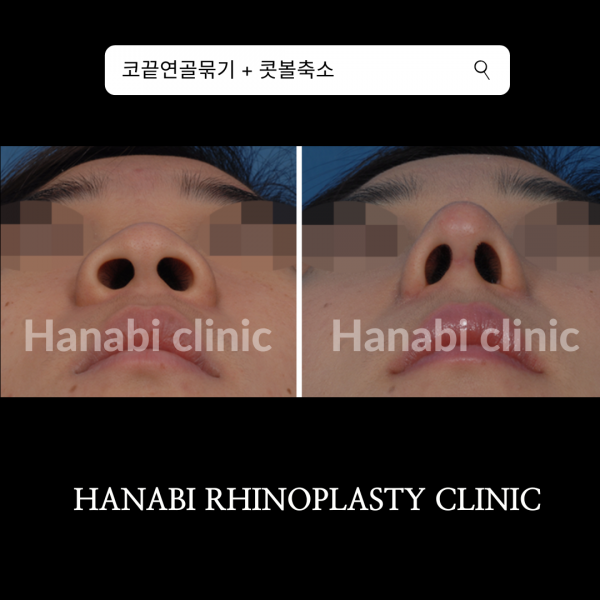 Before and after image of rhinoplasty for bulbous rounded tip HANABI