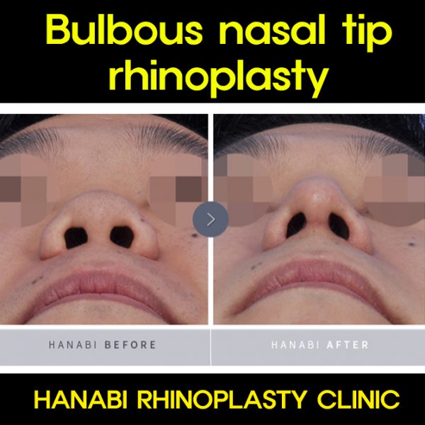 Bulbous nasal tip rhinoplasty HANABI RHINOPLASTY CLINIC