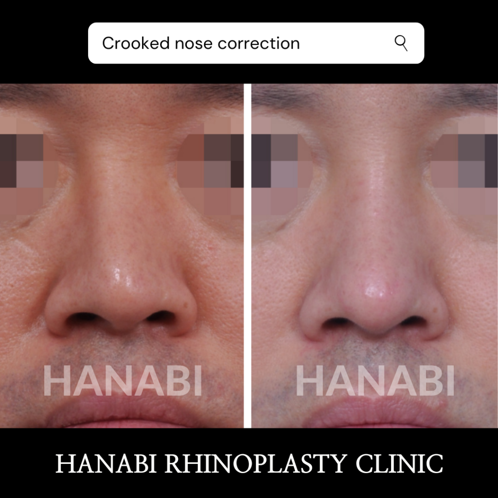 Nostrils Asymmetry Revision After Rhinoplasty HANABI RHINOPLASTY CLINIC