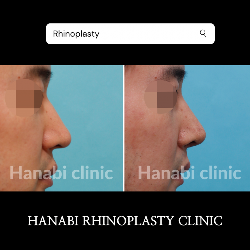 Deviated And Hump Nose Rhinoplasty Before And After Hanabi Rhinoplasty Clinic