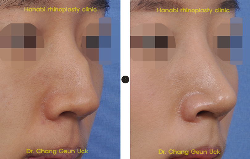 Hanabi’s nasal bump removal surgery before and after HANABI