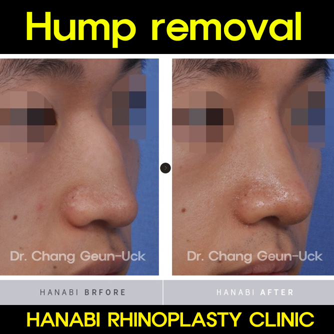 Hump Removal And Tip Reduction Hanabi Rhinoplasty Clinic 
