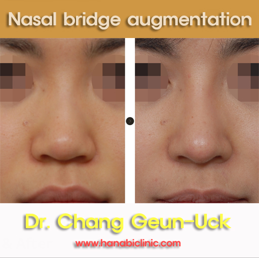 Nasal bridge augmentation HANABI RHINOPLASTY CLINIC