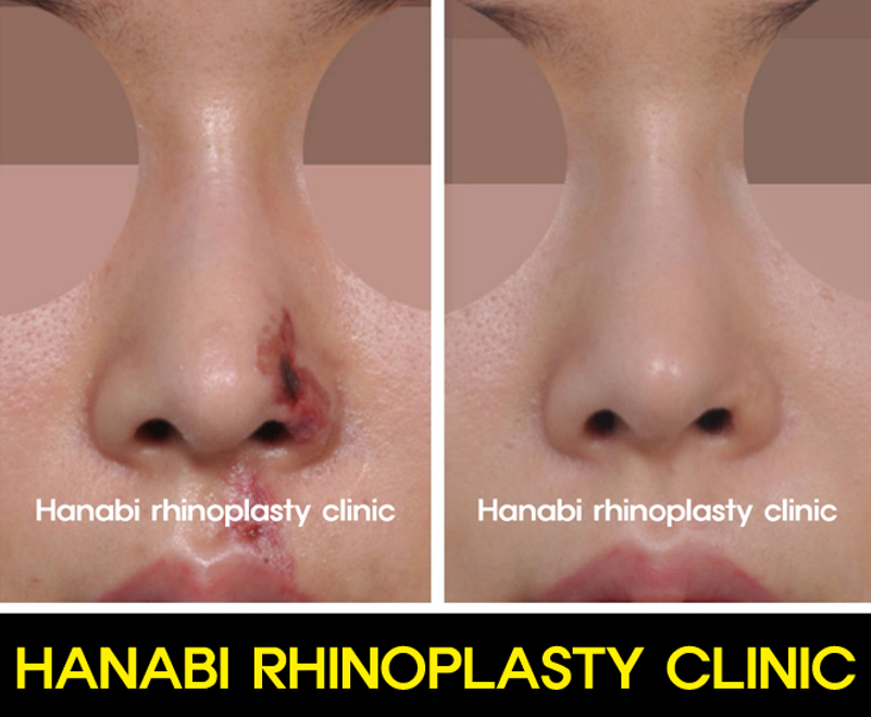 Nasal skin necrosis treament HANABI RHINOPLASTY CLINIC