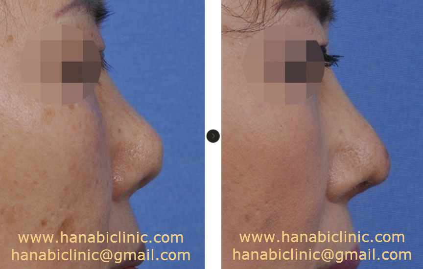Nose tip reconstruction using nasal tip skin flap HANABI RHINOPLASTY