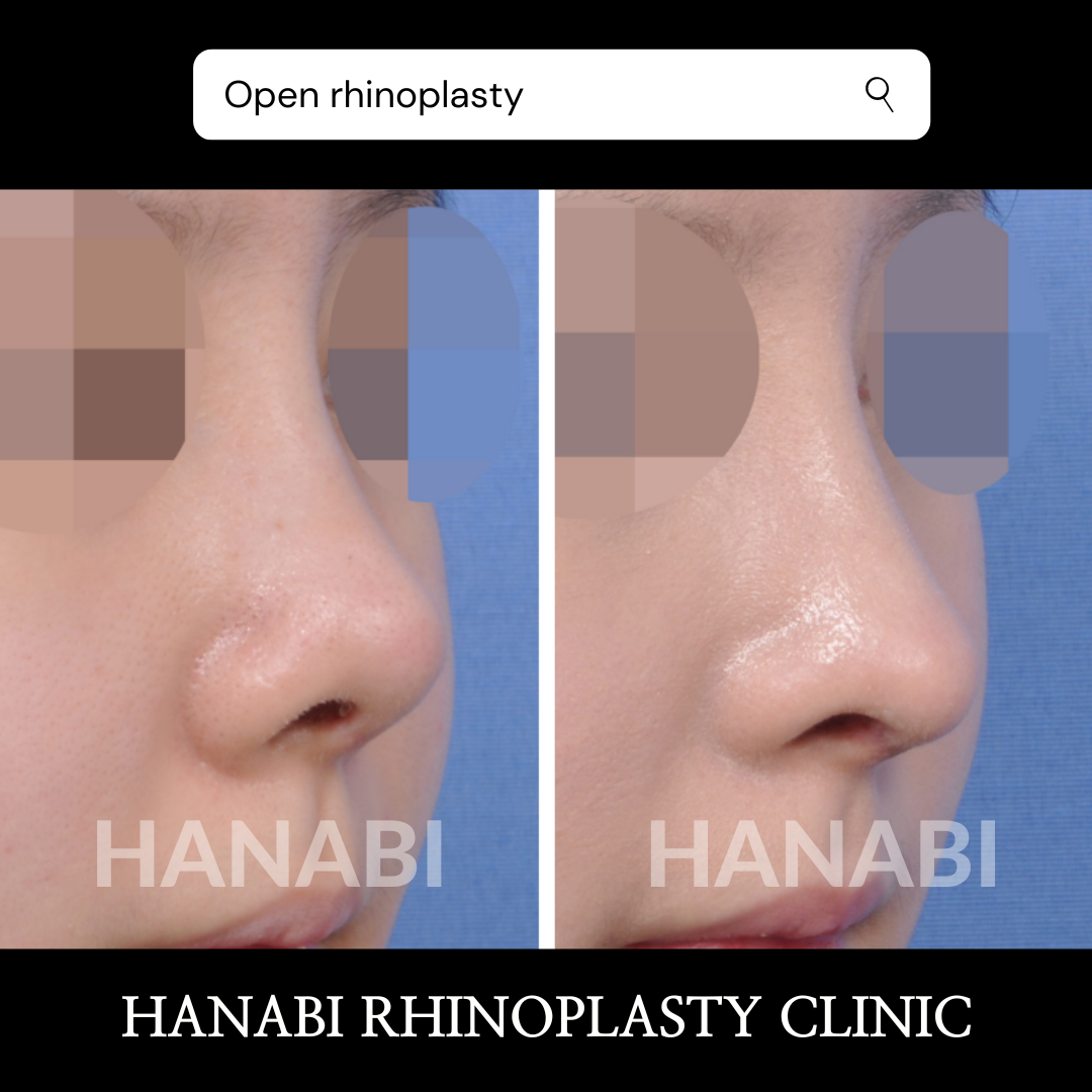 Open VS Closed rhinoplasty HANABI RHINOPLASTY CLINIC