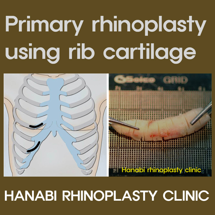 Primary Rhinoplasty Using Rib Cartilage HANABI RHINOPLASTY CLINIC