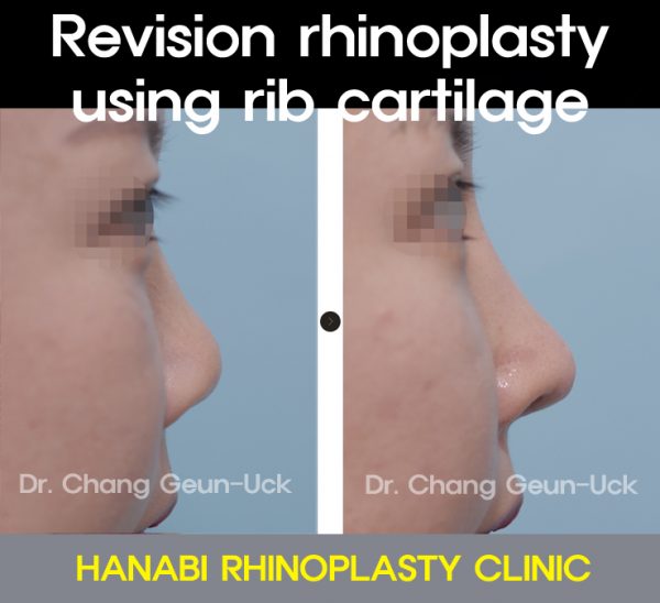 Revision rhinoplasty using rib cartilage HANABI RHINOPLASTY CLINIC