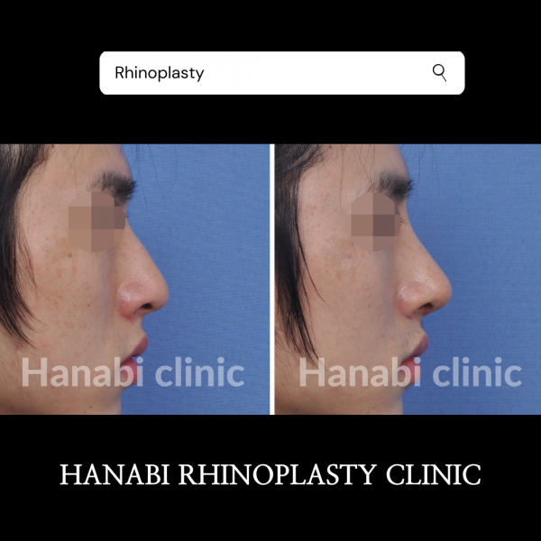 Rhinoplasty Before and After: Deviated Nose Surgery and