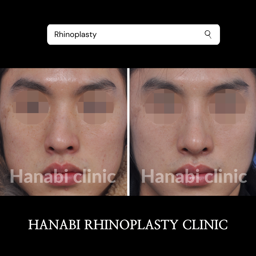 Rhinoplasty Before and After: Deviated Nose Surgery and