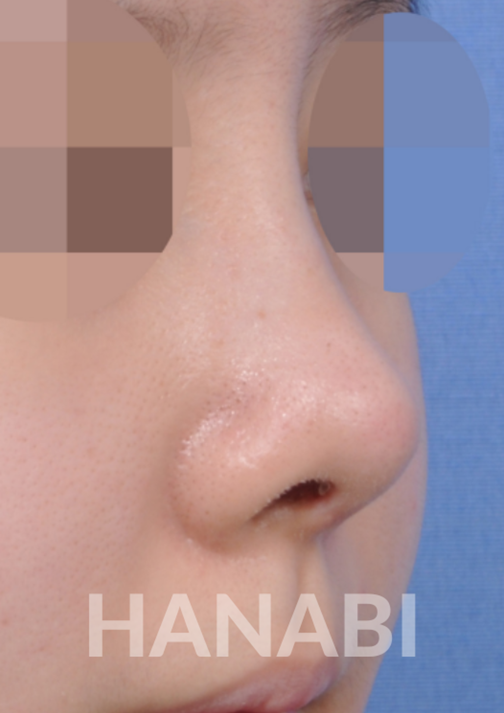 Short nose rhinoplasty HANABI RHINOPLASTY CLINIC