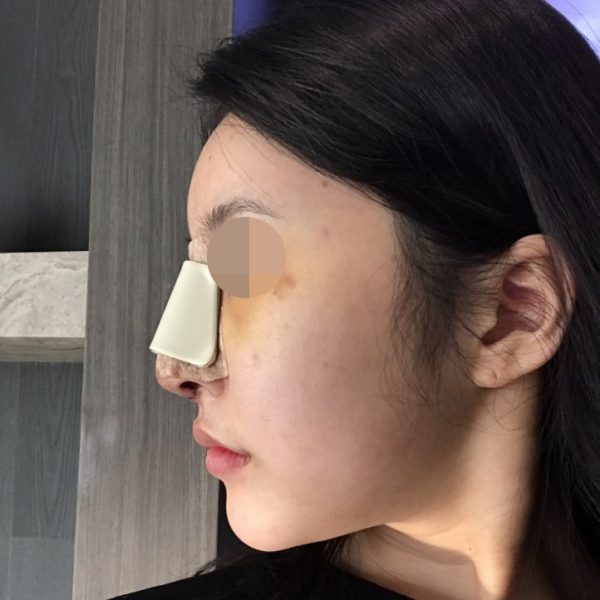 Why are nasal splints used after rhinoplasty HANABI RHINOPLASTY CLINIC