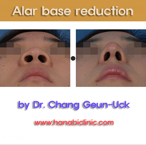 Alar Base Reduction Hanabi Rhinoplasty Clinic