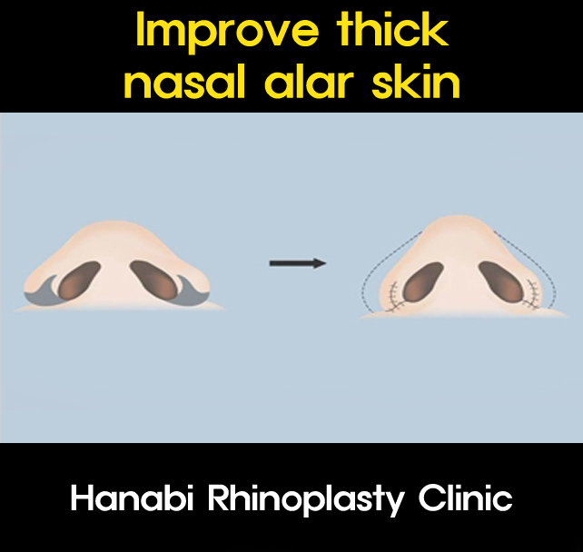 Alar base reduction surgery HANABI RHINOPLASTY CLINIC