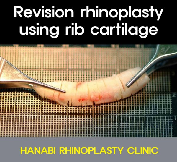 Revision rhinoplasty using rib cartilage HANABI RHINOPLASTY CLINIC
