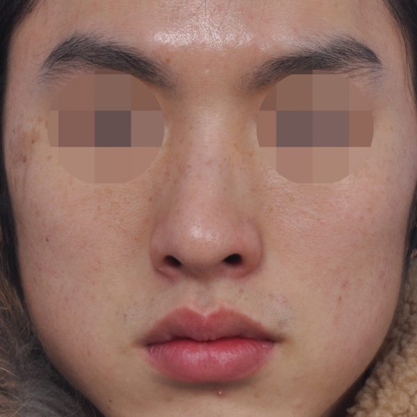 Rhinoplasty Before and After: Deviated Nose Surgery and