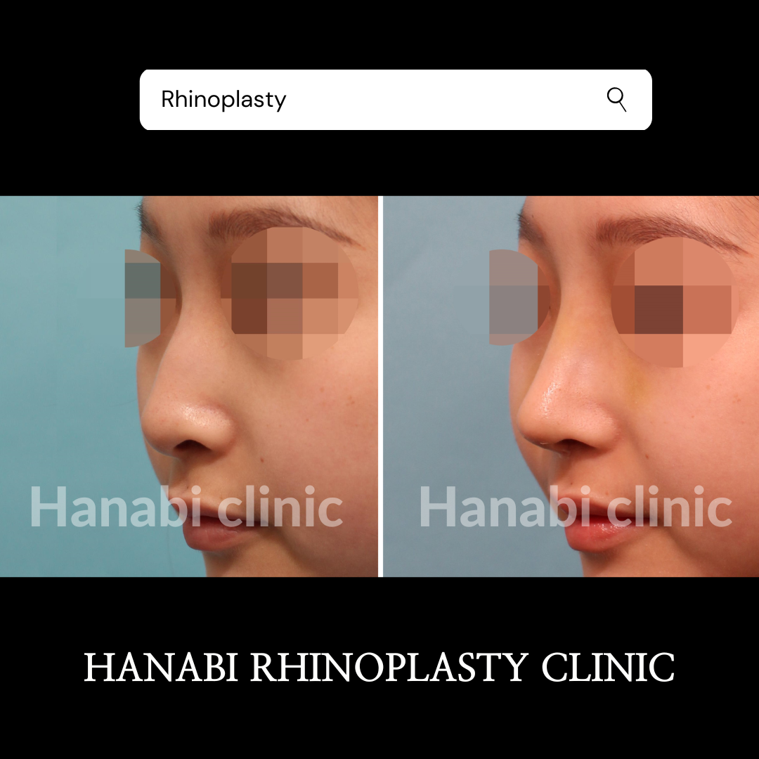 flat-nose-rhinoplasty-4.png