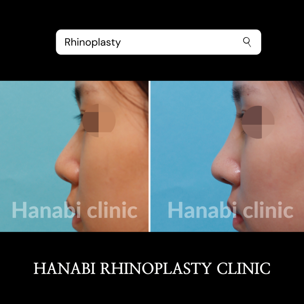 Before and after image of primary rhinoplasty for flat nose HANABI