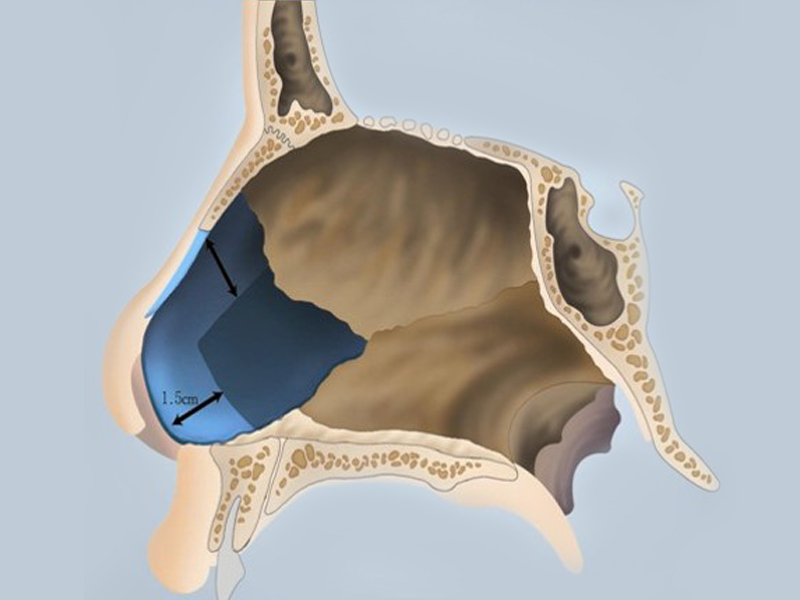 nasal septum,paranasal sinuses nasal septum rhinoplasty