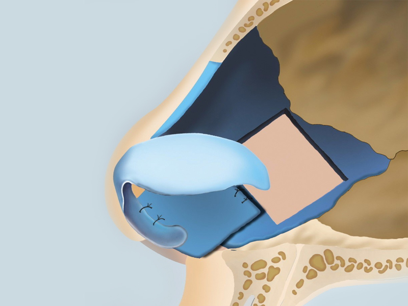 nasal-septum-rhinoplasty-hanabi-rhinoplasty-clinic