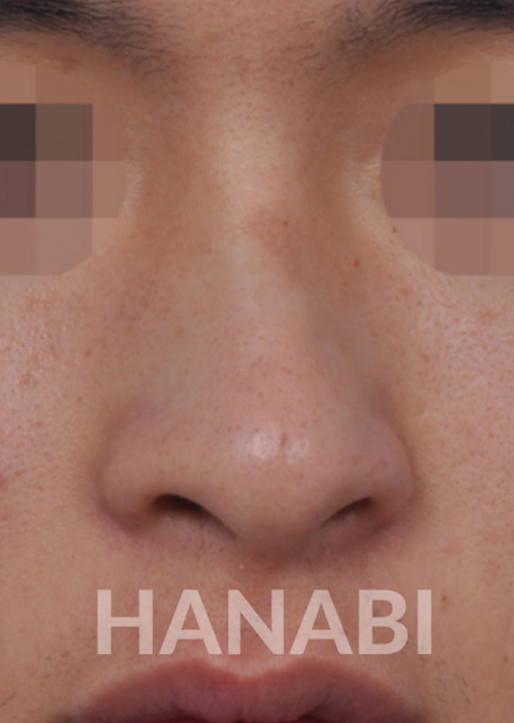 Hump Nose Hanabi Rhinoplasty Clinic