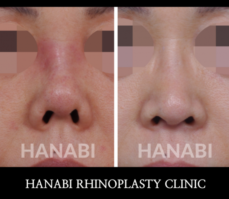 infection nose HANABI RHINOPLASTY CLINIC