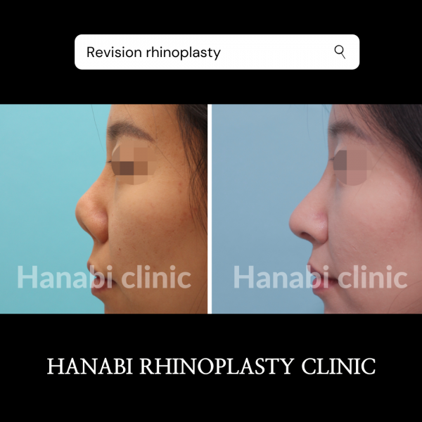 nasal-contracture-revision-