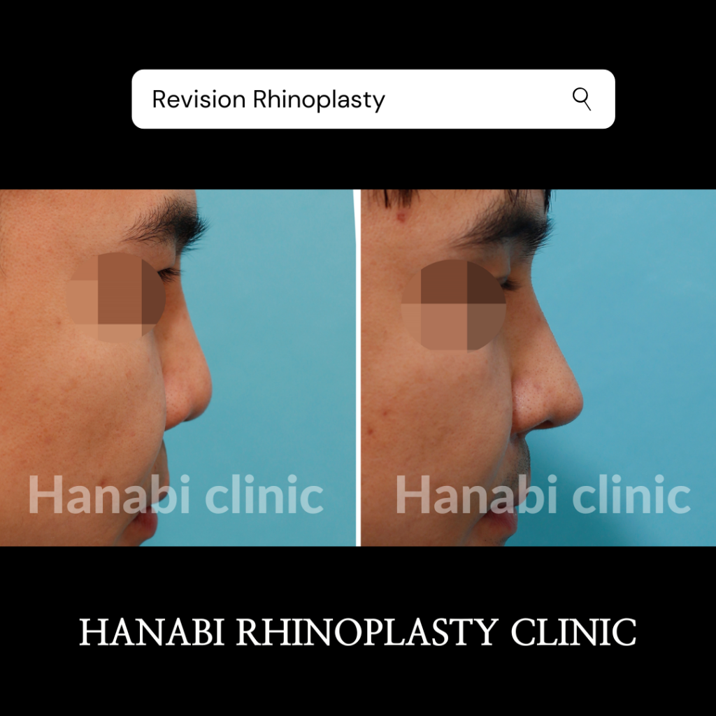 【裁断済】Rhinoplasty (鼻整形) I ジョン・ドンハク Zetith Beauty Clinic 鉄理事長による鼻整形の教科書が待望の第