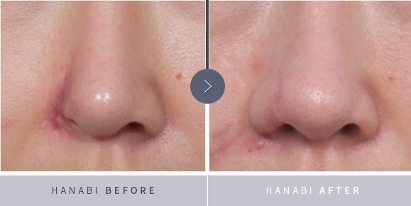 Nasal Reconstruction Surgery – HANABI RHINOPLASTY CLINIC