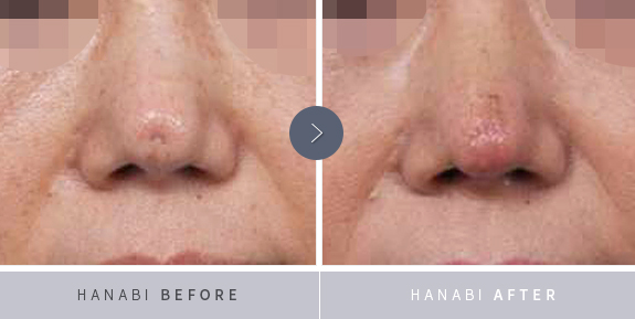 Nasal Reconstruction Surgery – HANABI RHINOPLASTY CLINIC