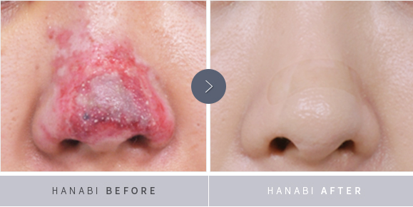 Nasal Reconstruction Surgery – HANABI RHINOPLASTY CLINIC