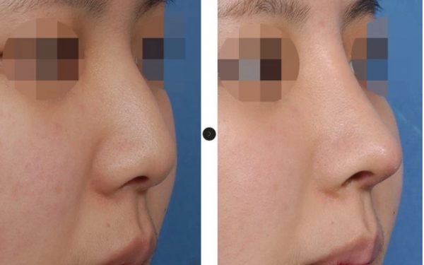 3 Best Clinics for a Nose Job in Korea