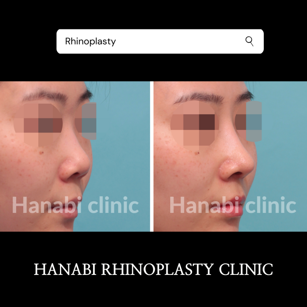 Asian Rhinoplasty Before And After Photos HANABI RHINOPLASTY CLINIC