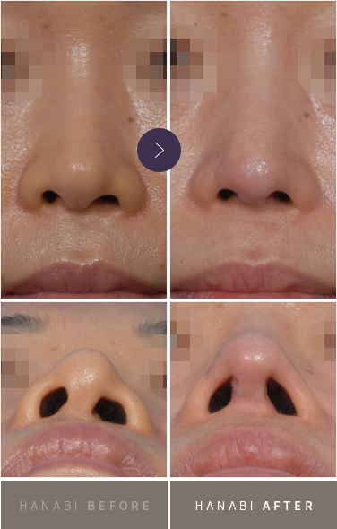 Cleft nasal deformity – HANABI RHINOPLASTY CLINIC