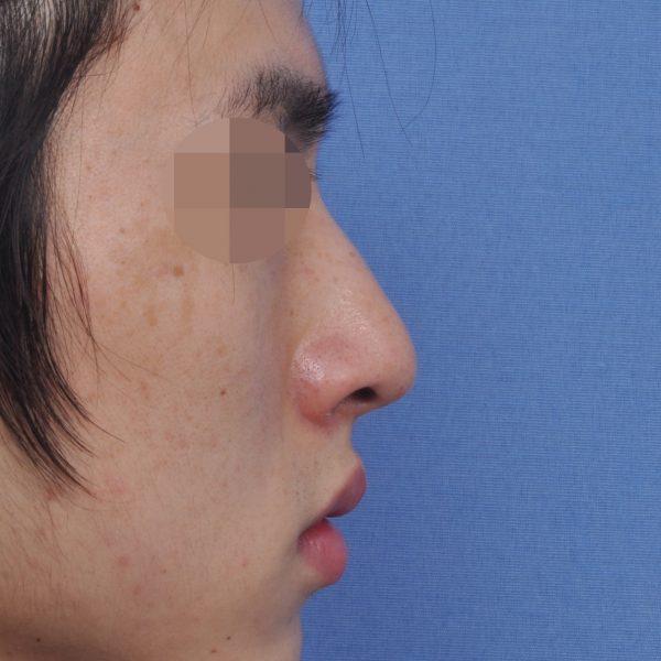 Rhinoplasty Before and After: Deviated Nose Surgery and